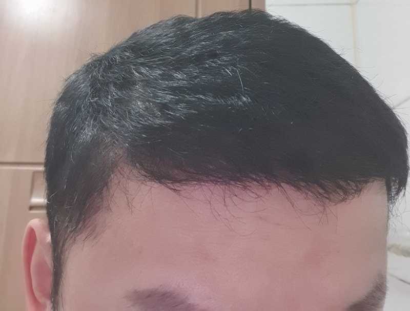 ヘアライン毛髪移植1年目のレビュー