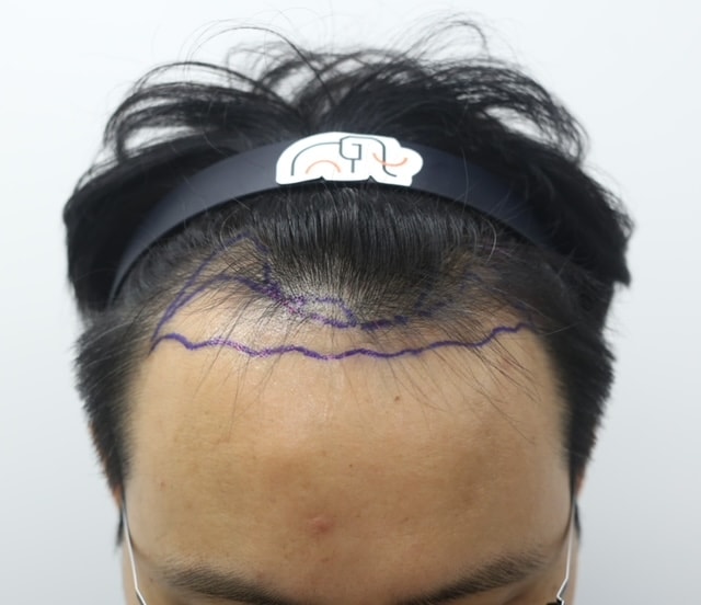 狎鴎亭 マンモス ヘアライン 男性 M字 毛髪移植 1日目 レビュー