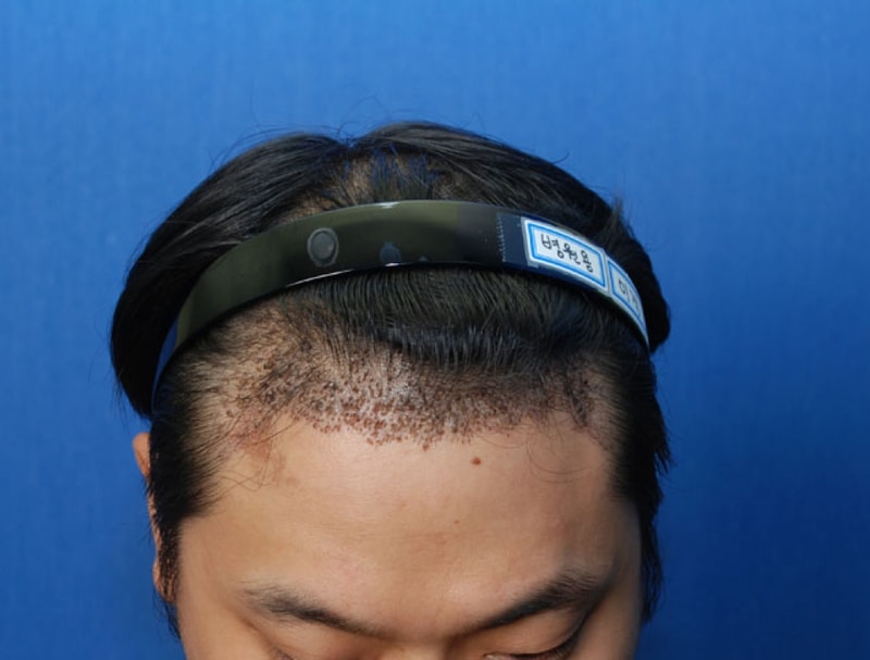 수술10일후1.JPG