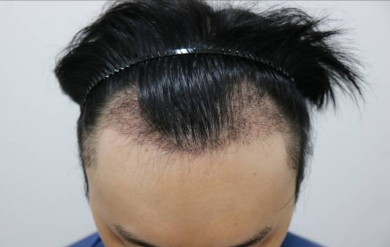 수술 후 한달경과.jpg