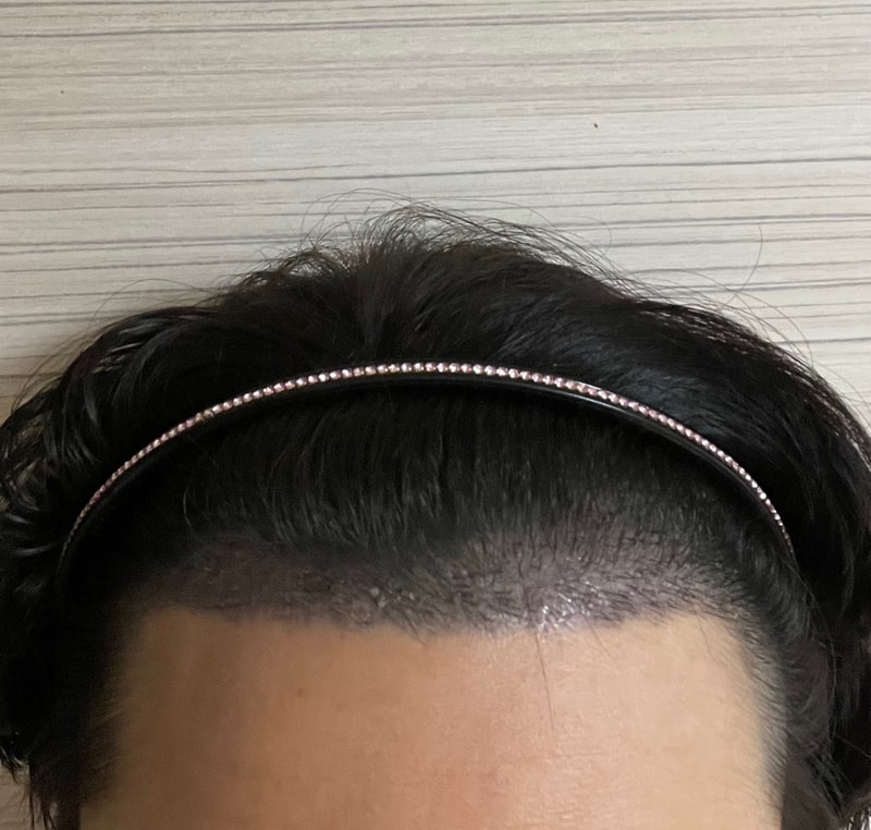 딱지제거 2.jpg
