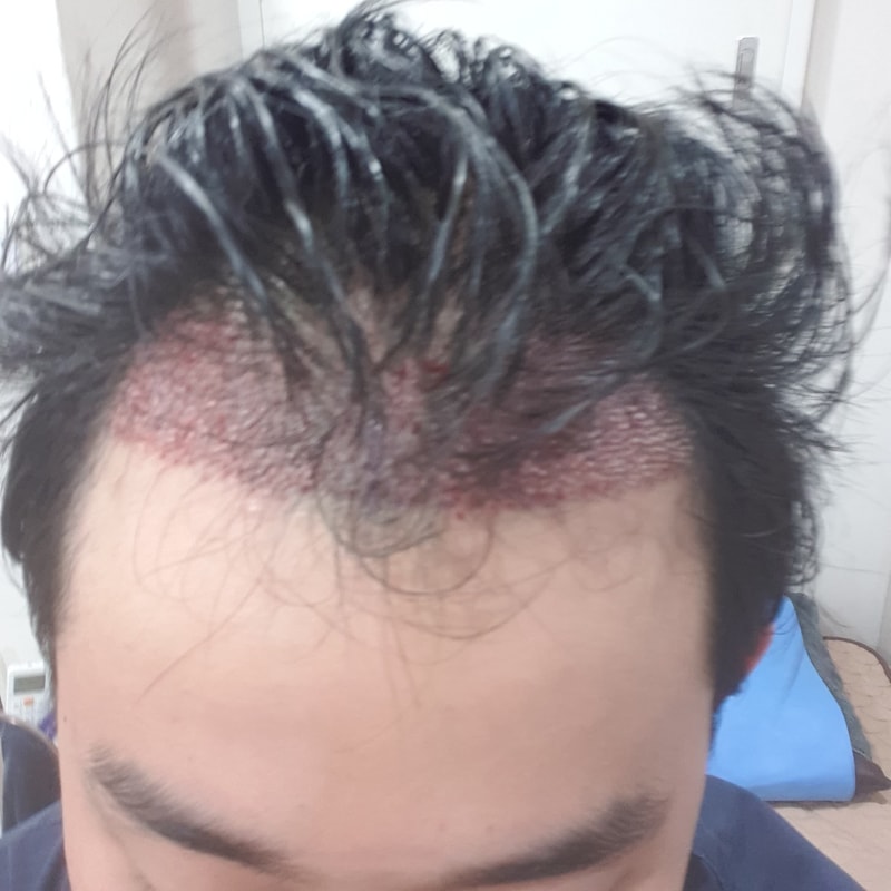 留下非切开1400毛囊手术后记