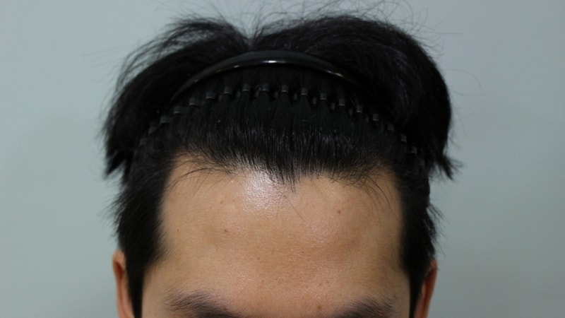 이식전3.jpg