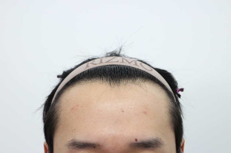 부산리즈모의원 모발이식2주차경과