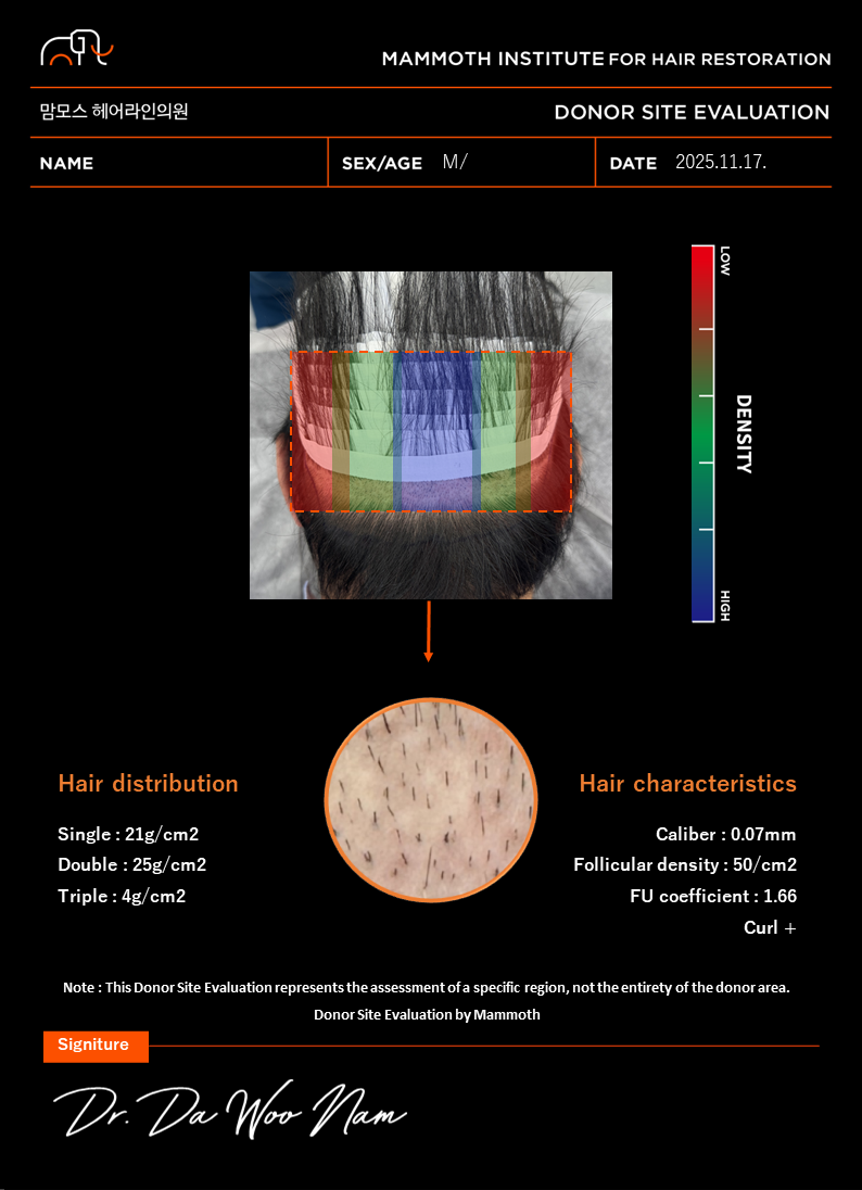 압구정 맘모스 비절개 모발이식 후기(3일차)