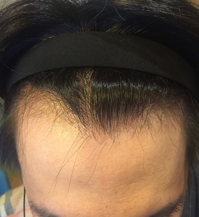 ニューヘア切開式の1年後です。