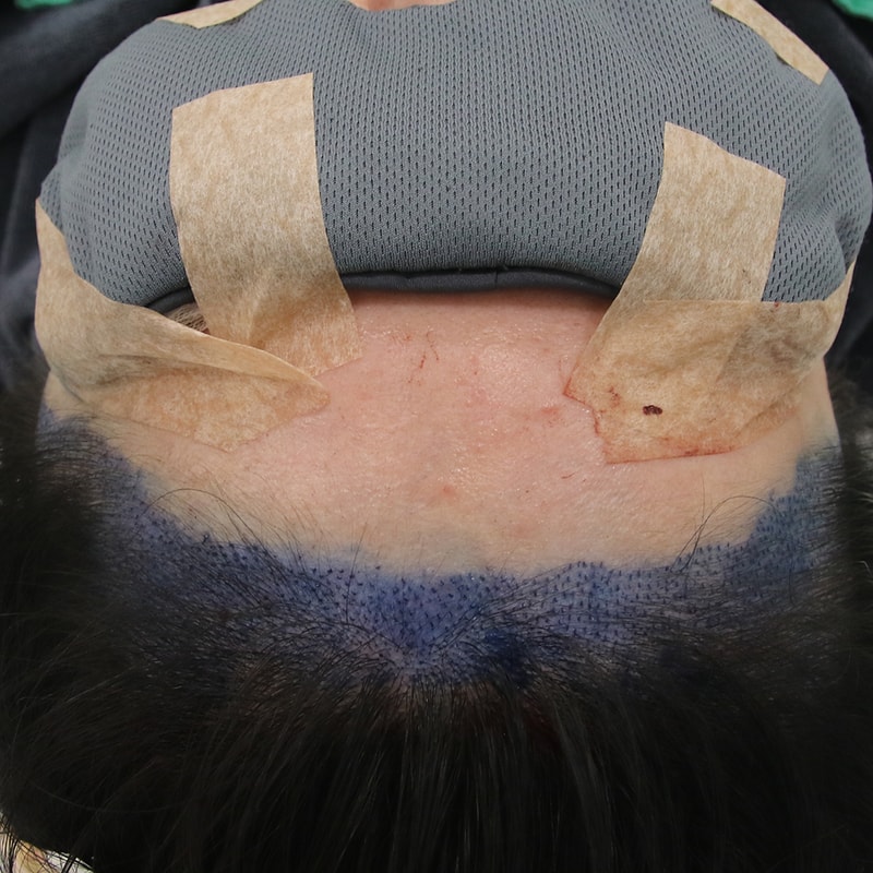 수술 슬릿.jpg
