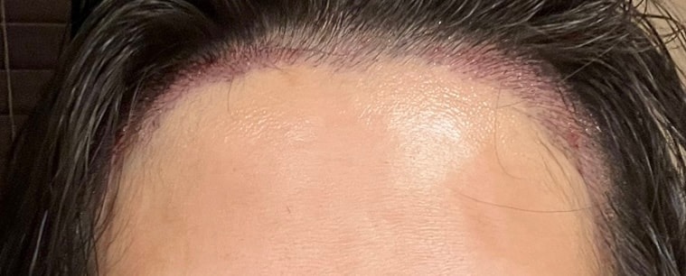 압구정 모우림의원 여성 헤어라인 모발이식 1500모