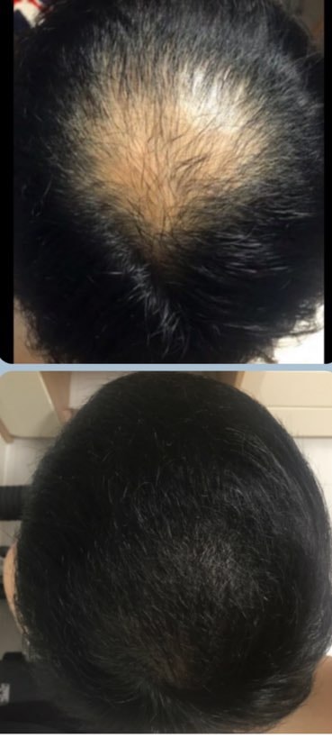 头顶毛发移植6个月评价