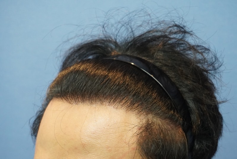 2.수술 1년후3.JPG