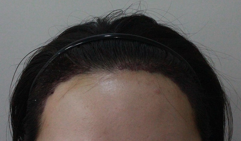 수술후-1일차_정면.jpg