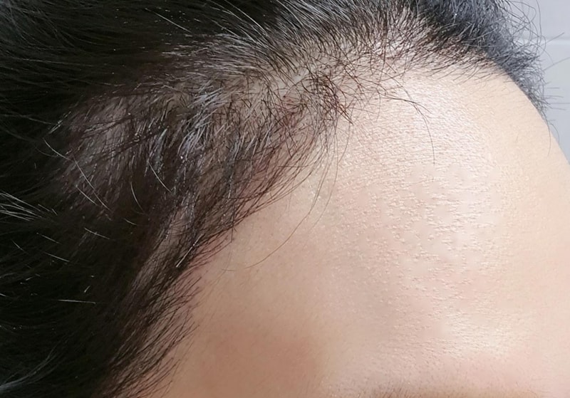 수술후_한달_측면2.jpg