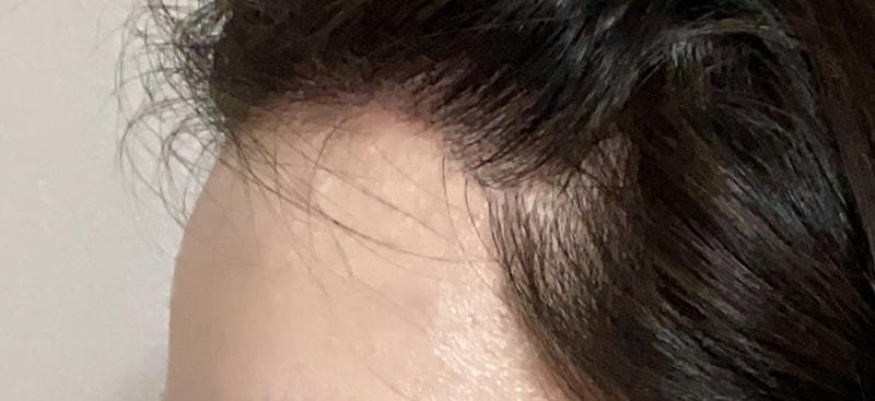 수술-후-262일-측면1.jpg