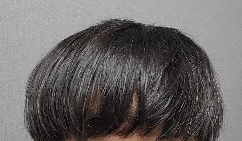 3.수술 1년 후2.jpg