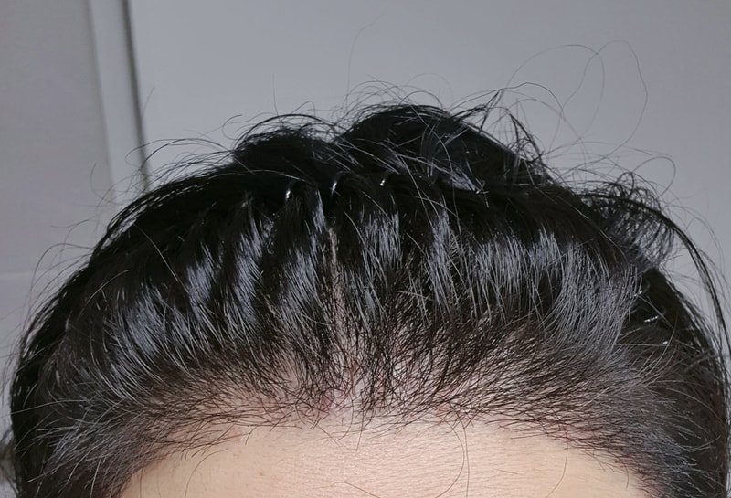 수술-후-21일-정면.jpg