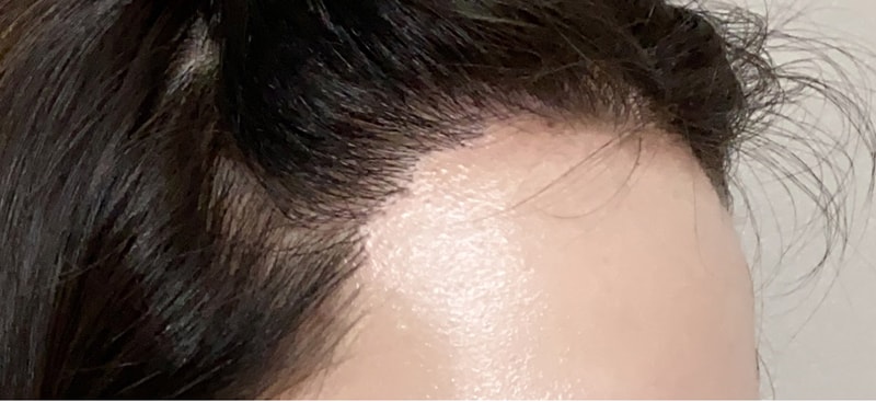 수술-후-262일-측면2.jpg