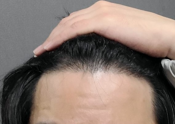 3.수술 1년 후1.jpg