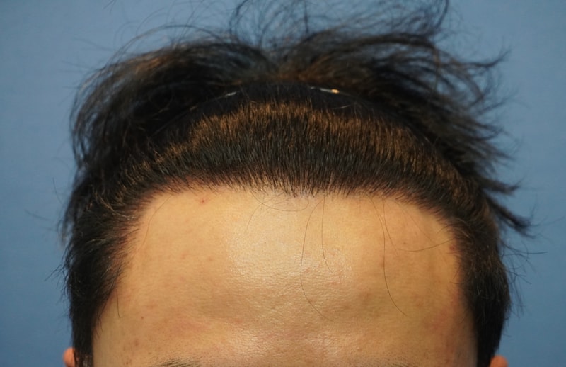 2.수술 1년후1.JPG