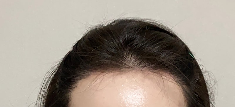 수술-후-262일-정면1.jpg