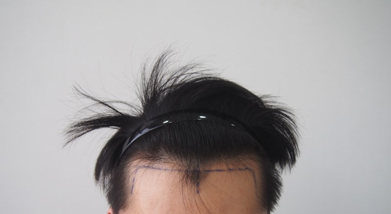 I received about 1000 hair follicle transplantation by non-excision in the parent body.