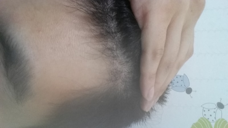 Review of the 4th month of non-cut 500 hair follicles