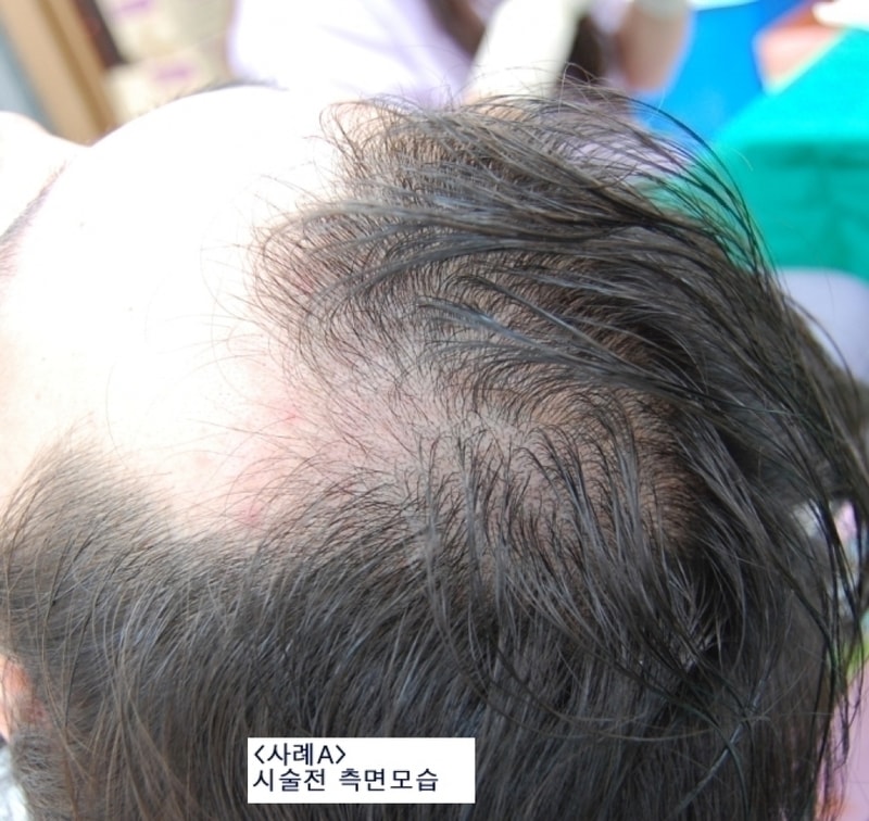 [Other] <Busan Hansung Hair Transplantation> Presence of residual hair at the transplant site and expressive power (result)