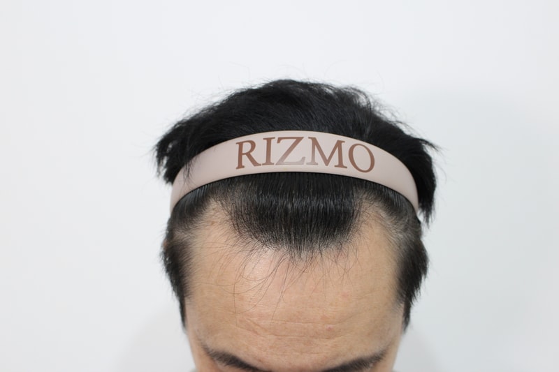 부산리즈모의원 모발이식2주차경과