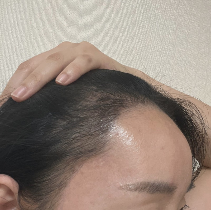 Grow医院（旧新发型釜山医院） 女性发际线 2000 毛发移植 3 个月后期