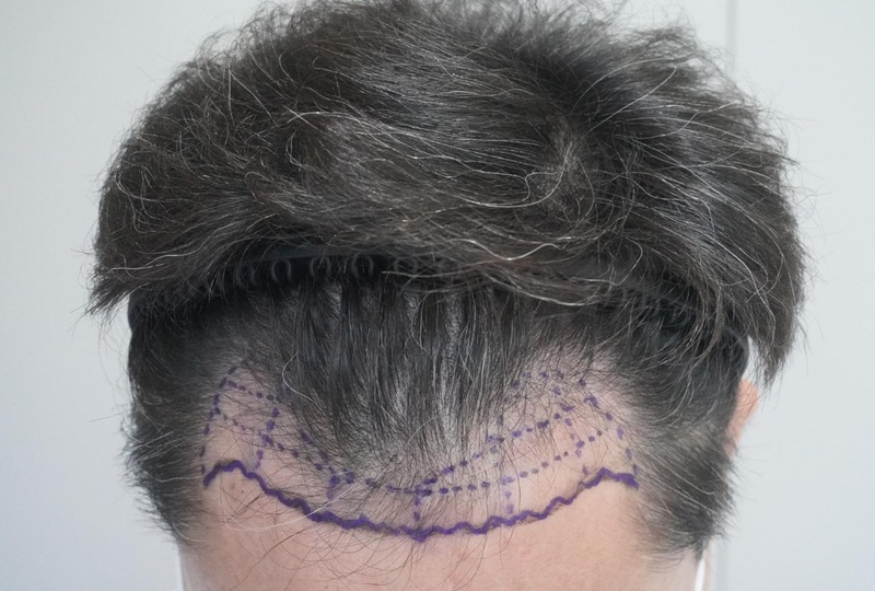 Glow Clinic (formerly New Hair Busan) The 1st Review of Hair Transplantation