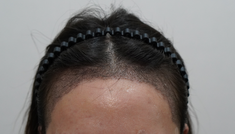 I went to Glow Clinic (formerly New Hair Busan) with a 3,500-mo hairline orthodontic transplant!