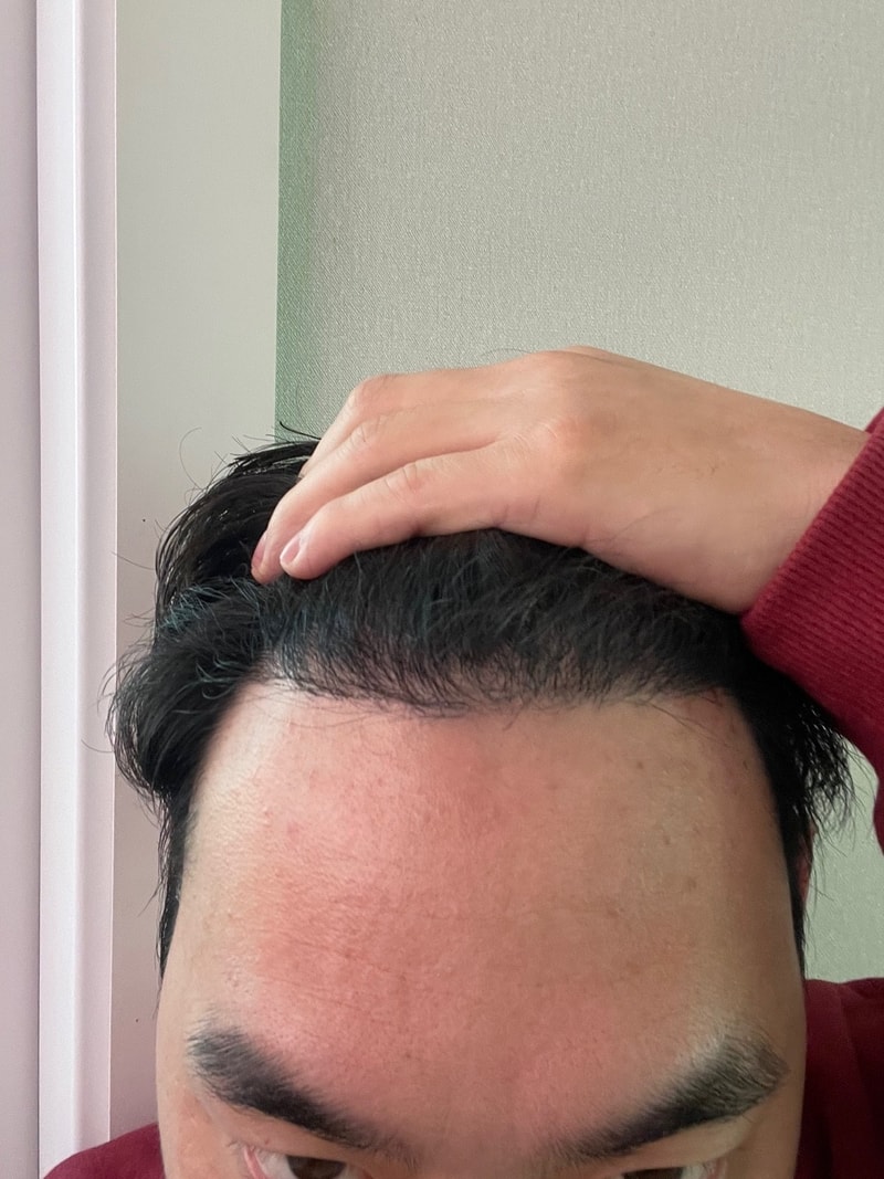 グロウ医院(旧ニューヘア釜山)の移植から6ヶ月目になりました！