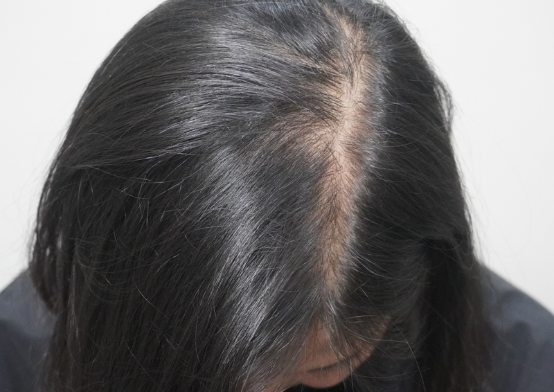 Glow Clinic (formerly New Hair Busan) Hair Transplantation 2,500 Mo 1 Month Review