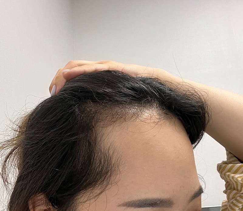 グロウ医院(旧ニューヘア釜山)女性ヘアライン矯正 2000毛 手術後のレビュー