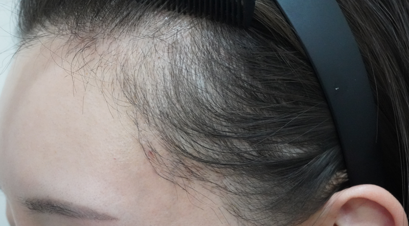 Glow Clinic (formerly New Hair Busan) Women's Hairline Correction Non-cut 3000 Mo Review