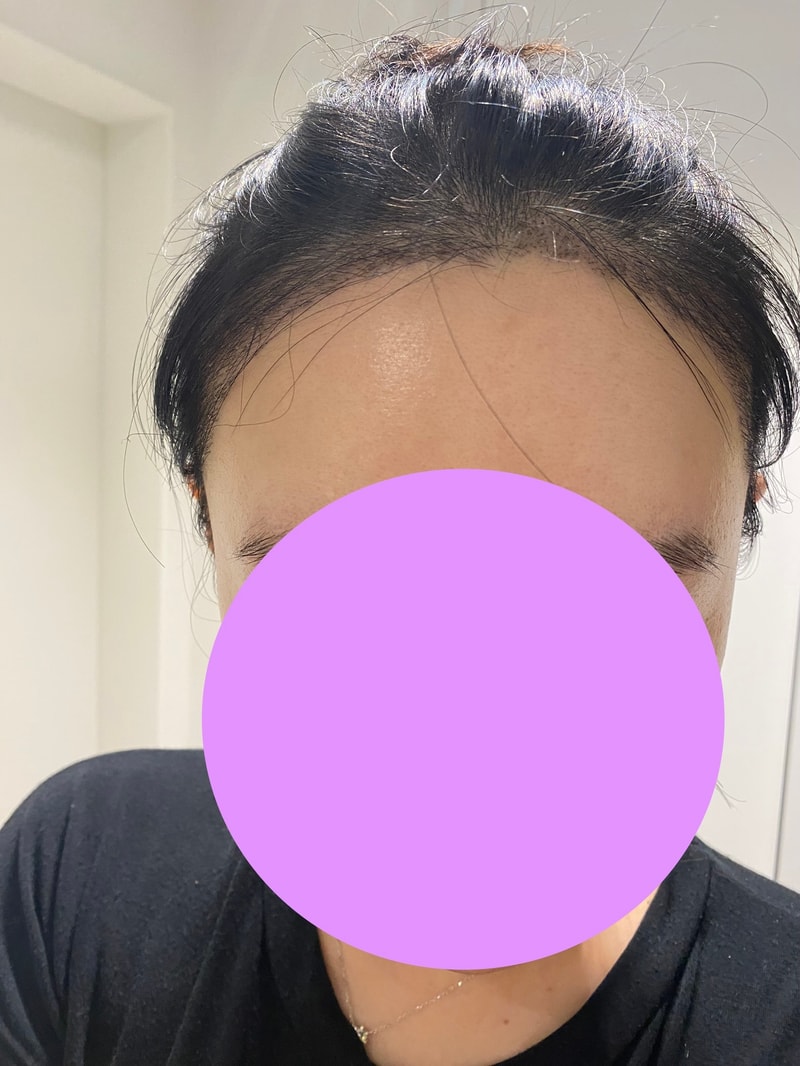 그로우의원(구 뉴헤어부산)비절개 모발이식 3500모 한달차 후기