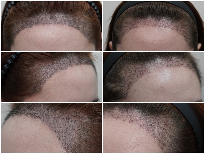 It's been a month since I got a hairline correction hair transplant at the Busan branch of New Hair!