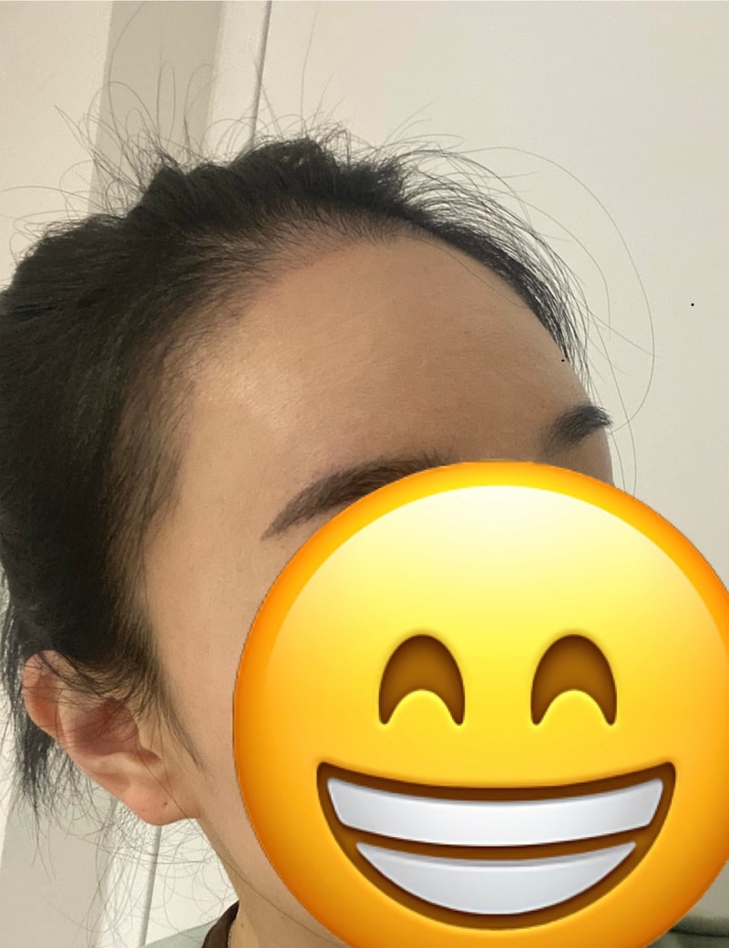그로우의원(구 뉴헤어부산)비절개 모발이식 3500모 3개월차 후기