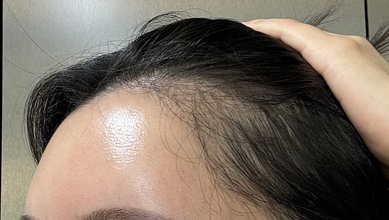 Glow Clinic (formerly New Hair Busan) Hairline Correction 3,000 Mo, 3 months have passed