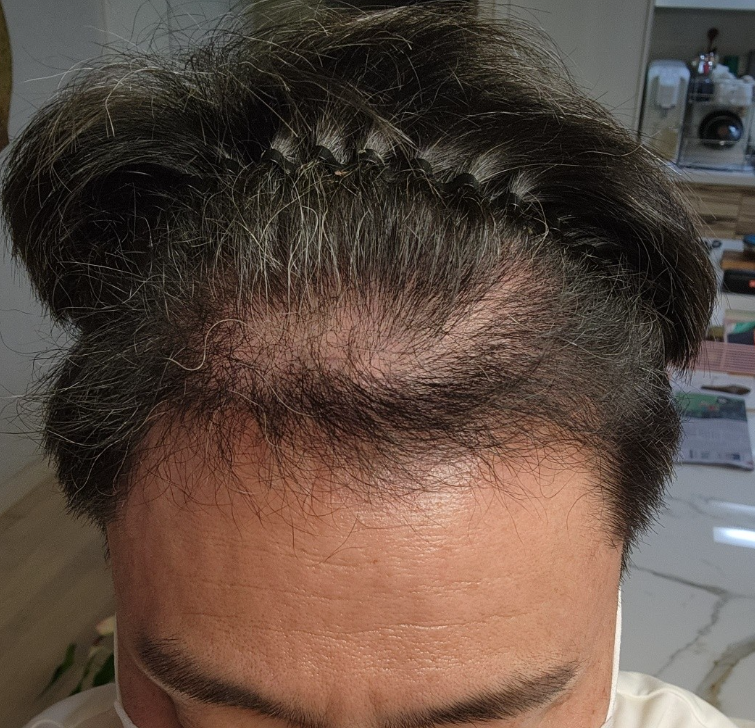 It's been about six months since I had a hair transplant at Glow Clinic (formerly Newer Busan)