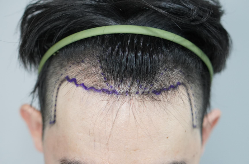 グロウ医院(旧ニューヘア釜山) 非切開 毛髪移植10日目の後期