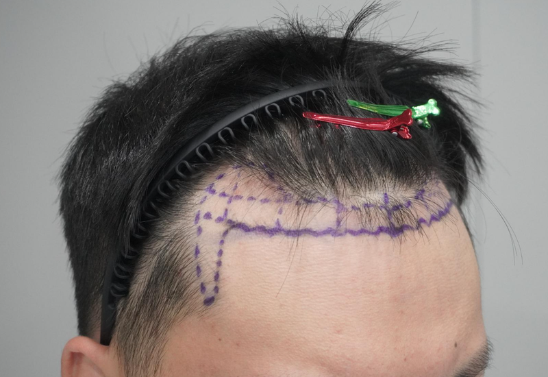 I got my first treatment at Grow Clinic (formerly New Hair Busan) after 4,500-mo surgery to correct the top of the head and hairline