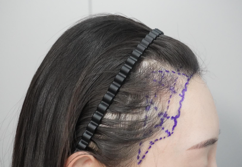Grow Clinic (formerly New Hair Busan) Hairline Correction Non-Cutting 3000 More Real Review