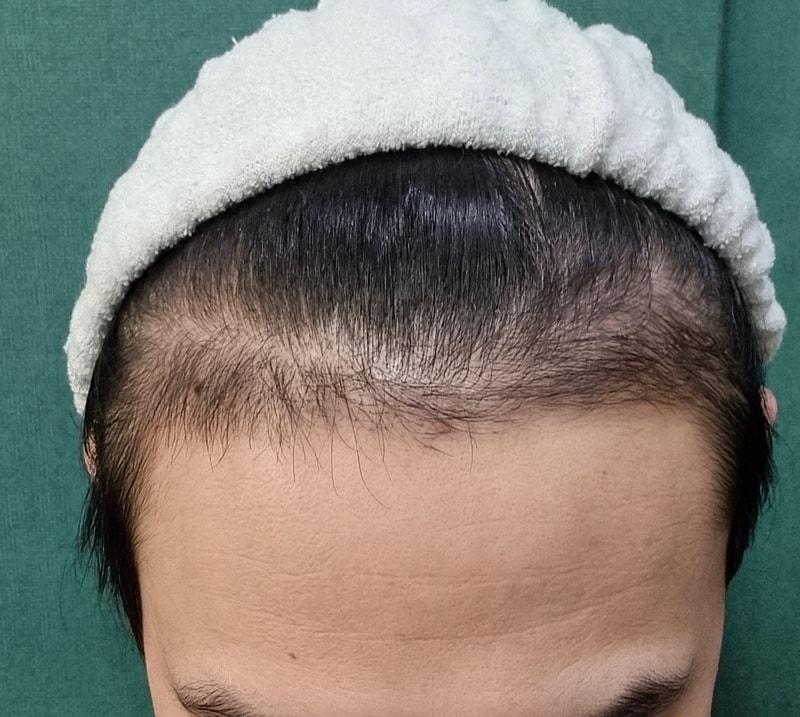 그로우의원(구 뉴헤어부산)에서 비절개 3000모 이식한지 3개월차