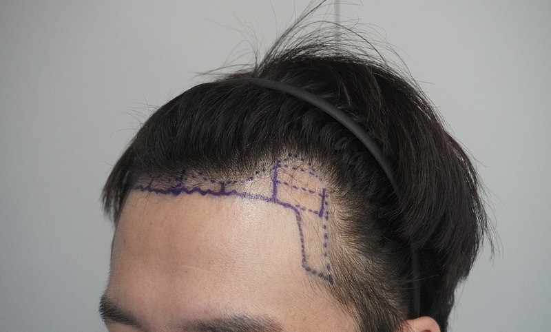 The 1st Review of Grow Clinic (formerly New Hair Busan) Hair Transplantation