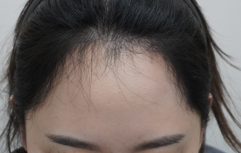 グロウ医院(旧ニューヘア釜山) 女性 ヘアライン 矯正 6ヶ月目 レビュー