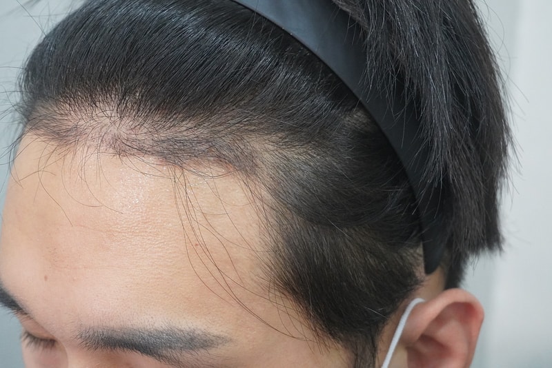 Grow Clinic (formerly Busan New Hair) Three-month review of 3,000 hair transplants