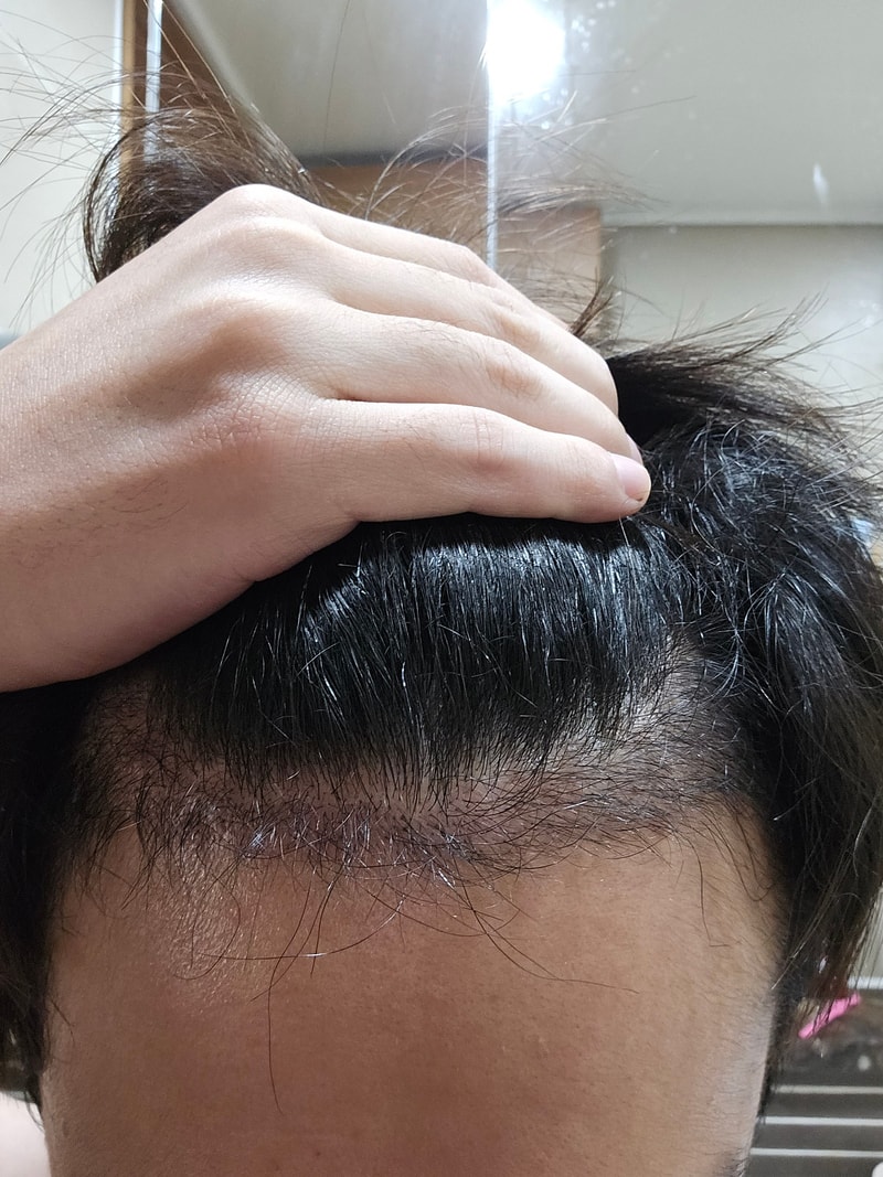 Glow Clinic (formerly New Hair Busan) Hair Transplantation Mza 3000 Mo 3 Months Review