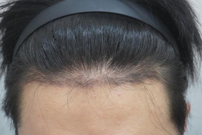 Glow Clinic [formerly New Hair Busan Branch] Hair Transplantation 1500 Hair follicle Emgysik 3 Months Review