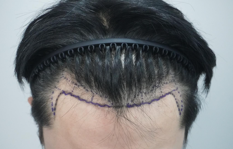 Review of Grow Clinic (formerly New Hair Busan) Surgery