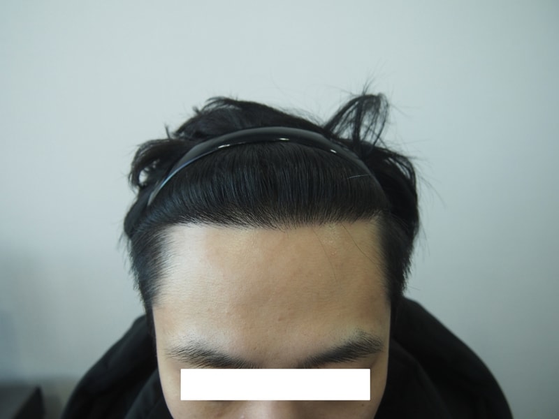 1300毛囊非切开13个月后期。